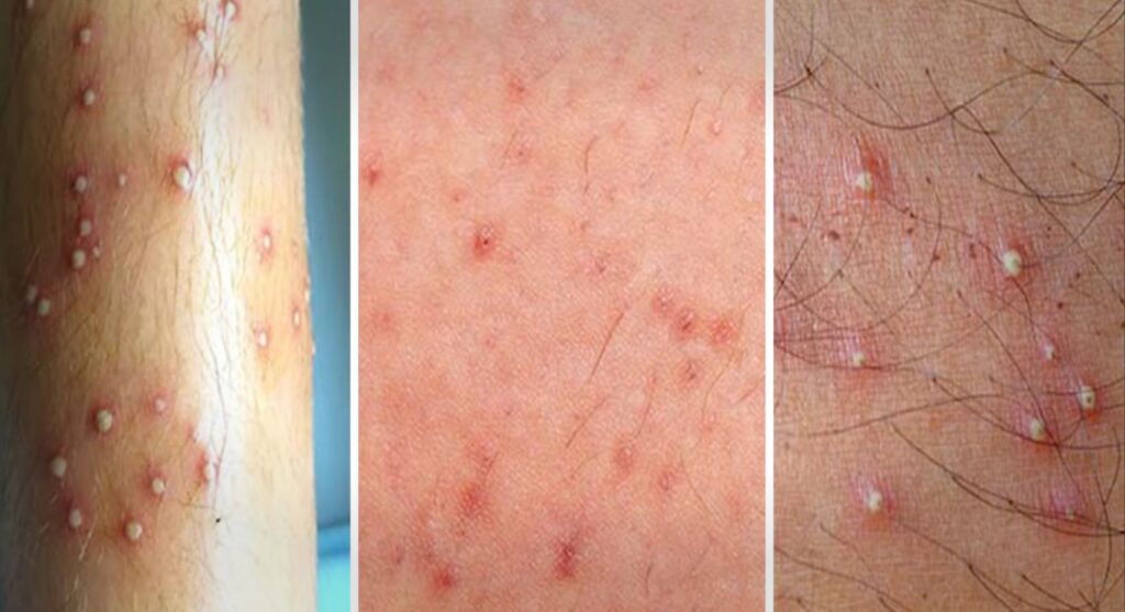 Summer में skin पर छोटे-छोटे लाल Pimple क्यों निकलते है?